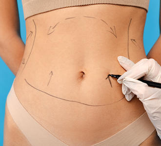 Karın Germe / Abdominoplasti