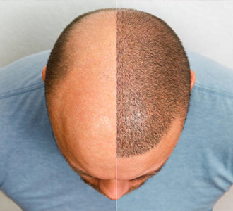 Haartransplantation